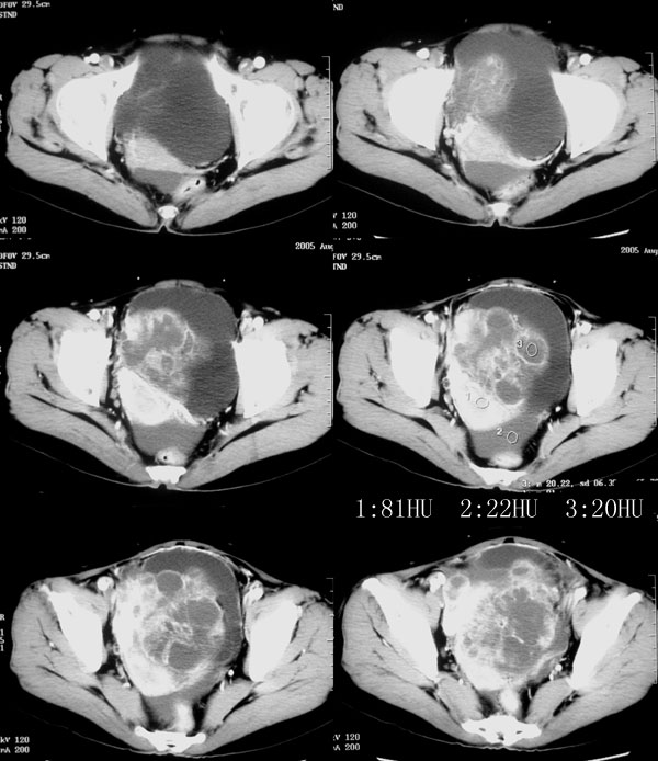 卵巢浆液性乳头状囊腺癌