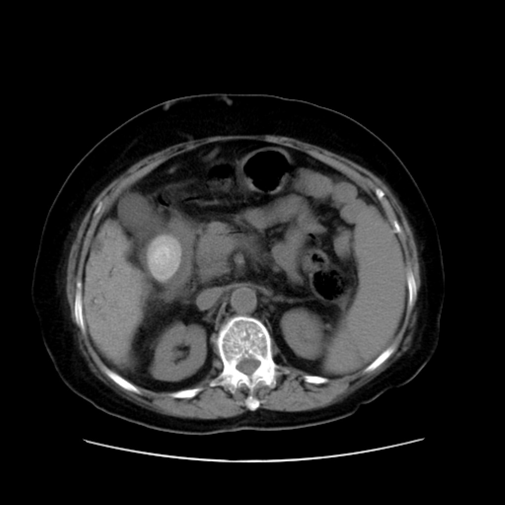 图2-10 胆囊结石声像图-腹部超声简易-医学