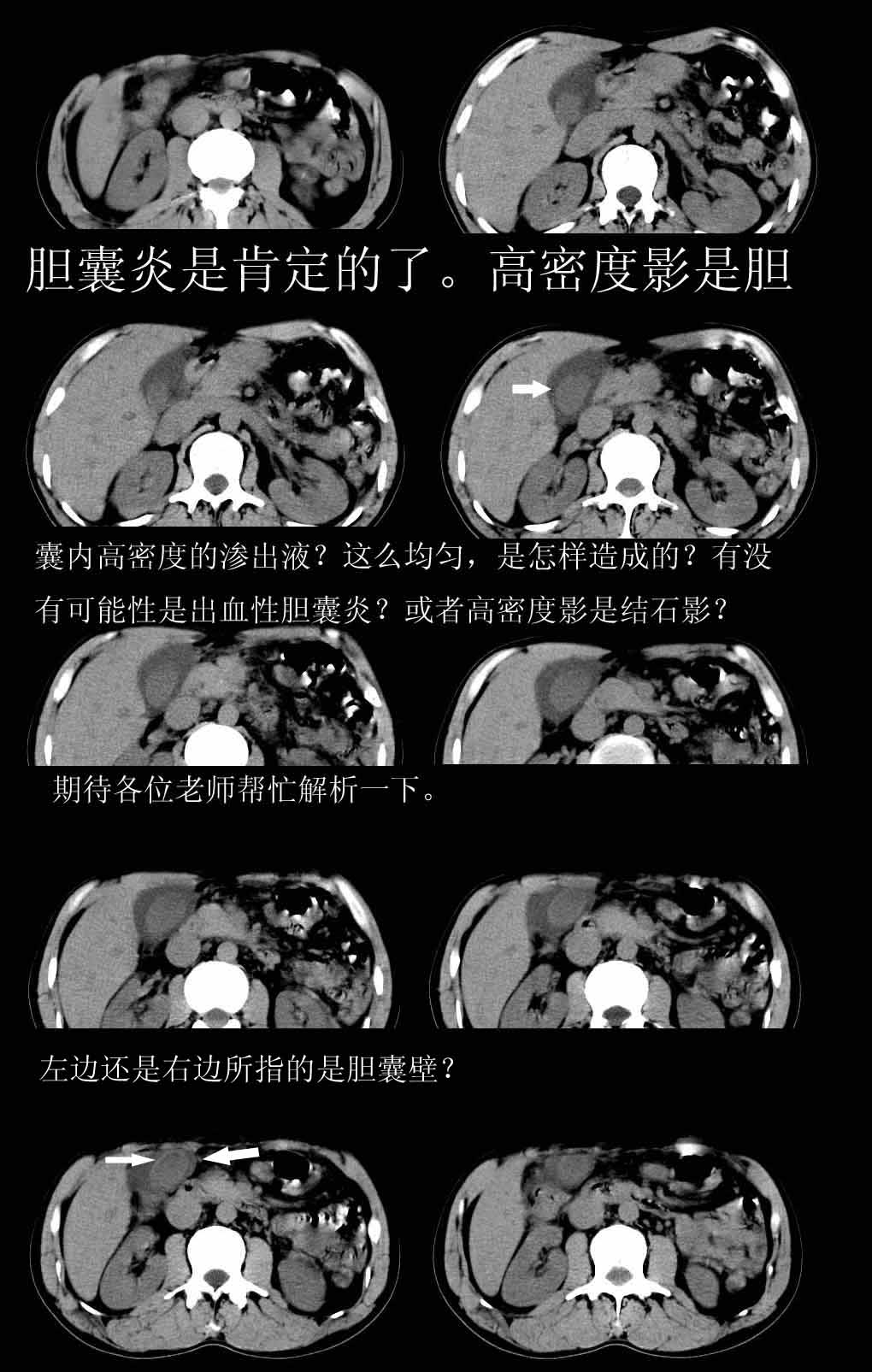 急性单纯水肿型胆囊炎